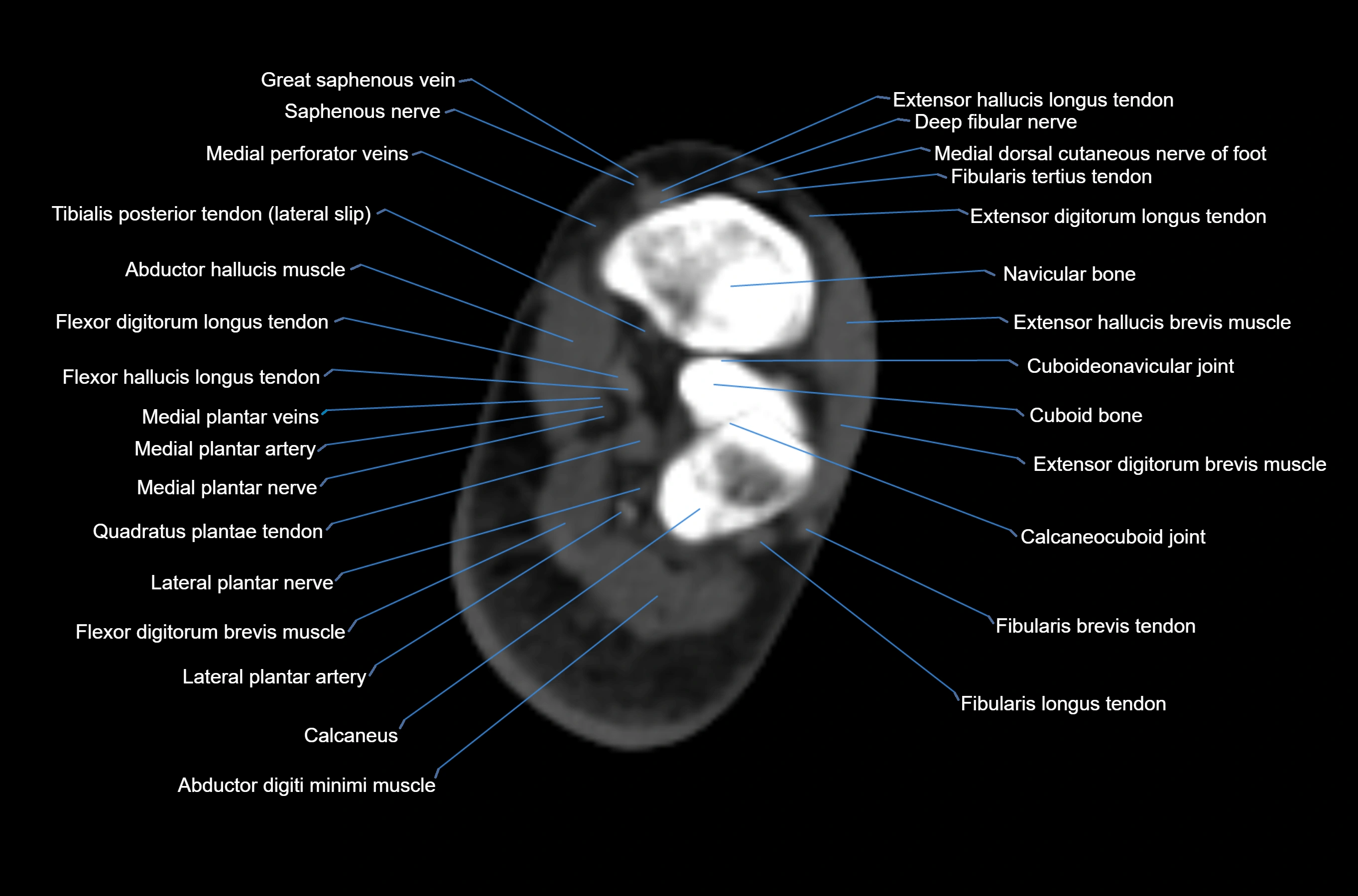 CT Ankle axial cross sectional anatomy labelled image -00046.webp